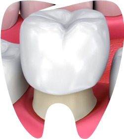 dental crowns-arixonafamilydentistry