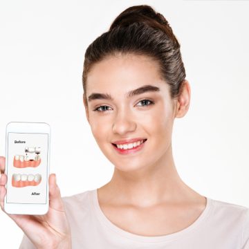 Dental Bridges Help Replace Lost Teeth to Assist in a Smile Makeover