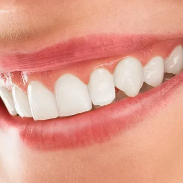 Teeth Whitening Myths vs. Facts: What You Need to Know for a Dazzling Smile