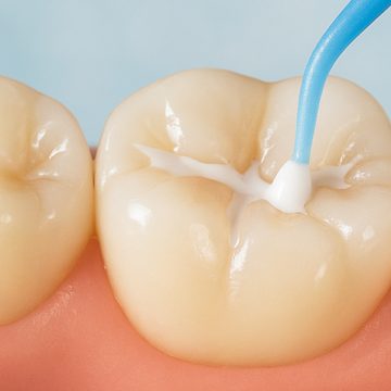 The Role of Dental Sealants in Protecting Your Teeth from Food Damage