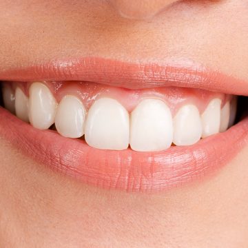 Did You Know That Teeth Whitening Can Last for Months, Depending on Your Diet and Habits?
